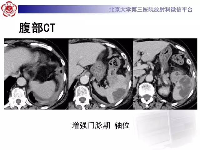 【病例】结肠癌继发脾脏脓肿1例CT