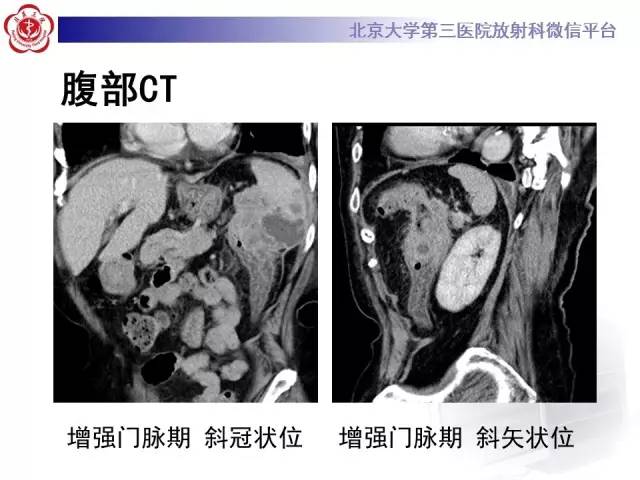 【病例】结肠癌继发脾脏脓肿1例CT
