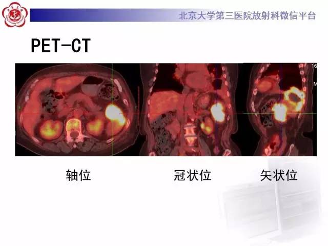 【病例】结肠癌继发脾脏脓肿1例CT