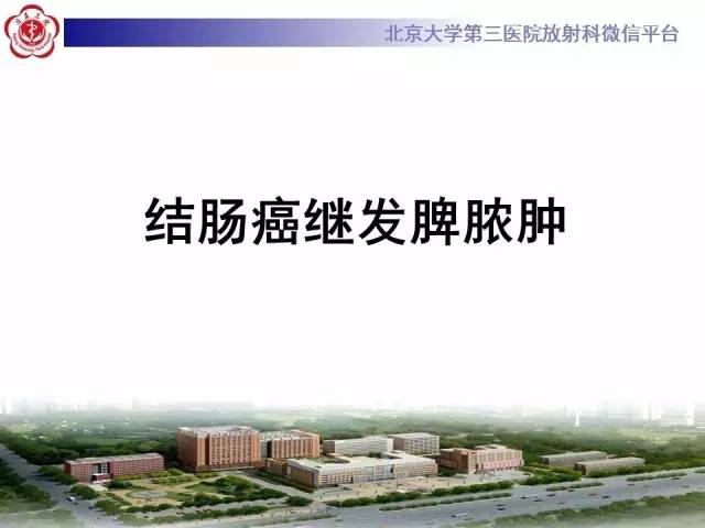 【病例】结肠癌继发脾脏脓肿1例CT