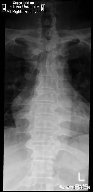 【病例】弥漫性特发性骨肥厚1例X线