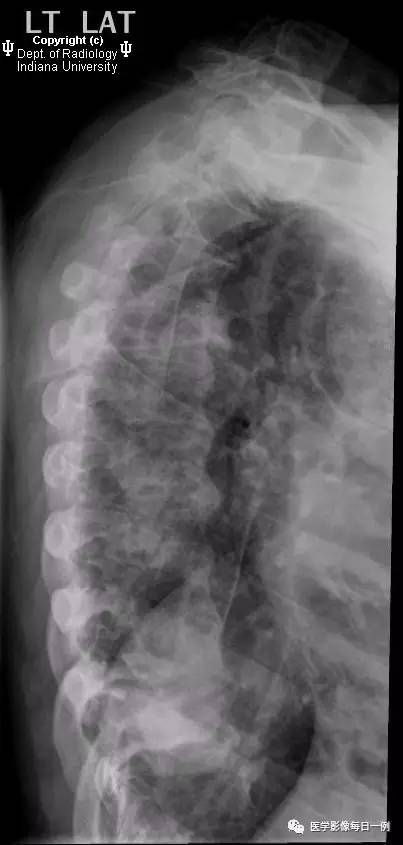 【病例】弥漫性特发性骨肥厚1例X线