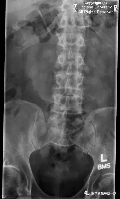 【病例】弥漫性特发性骨肥厚1例X线