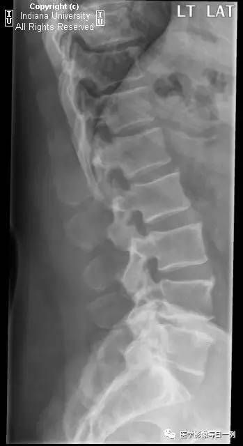 【病例】弥漫性特发性骨肥厚1例X线