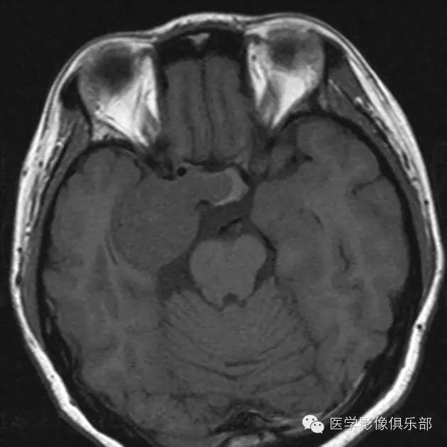颅内脑外海绵状血管瘤 颅内脑外海绵状血管瘤