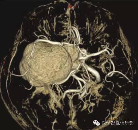 颅内脑外海绵状血管瘤 颅内脑外海绵状血管瘤