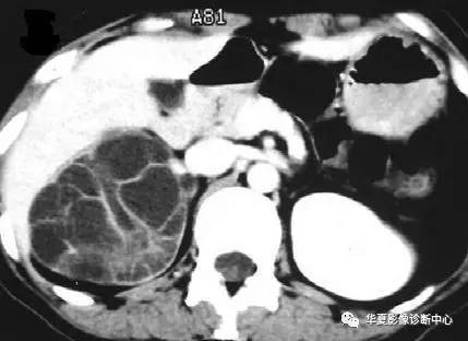 肾脏囊性病灶没那么简单