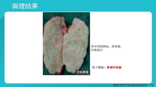 【病例】骨硬纤维瘤1例X线CT及MR