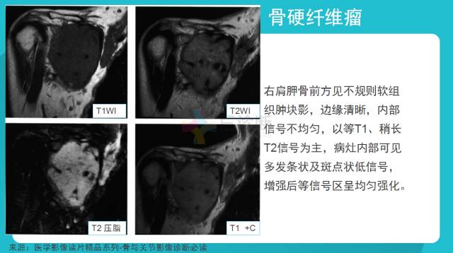 【病例】骨硬纤维瘤1例X线CT及MR