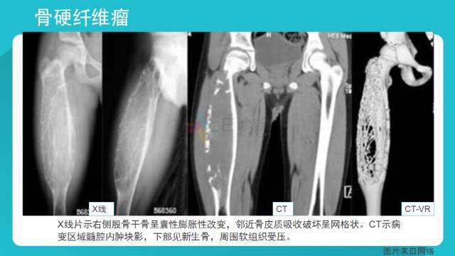 【病例】骨硬纤维瘤1例X线CT及MR