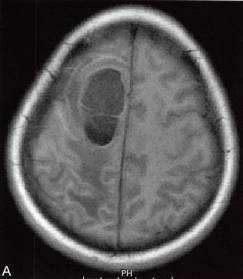 【病例】囊性脑膜瘤1例MR影像解析