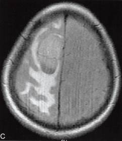 【病例】囊性脑膜瘤1例MR影像解析