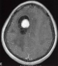 【病例】囊性脑膜瘤1例MR影像解析