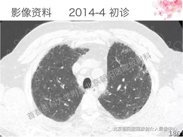 【三甲读片】这例看似肺炎的病变,多数人会误诊 【三甲读片】这例看似肺炎的病变,多数人会误诊