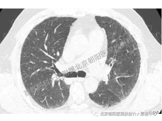 【三甲读片】这例看似肺炎的病变,多数人会误诊 【三甲读片】这例看似肺炎的病变,多数人会误诊