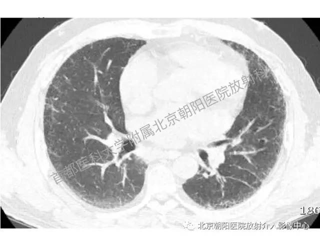 【三甲读片】这例看似肺炎的病变,多数人会误诊 【三甲读片】这例看似肺炎的病变,多数人会误诊