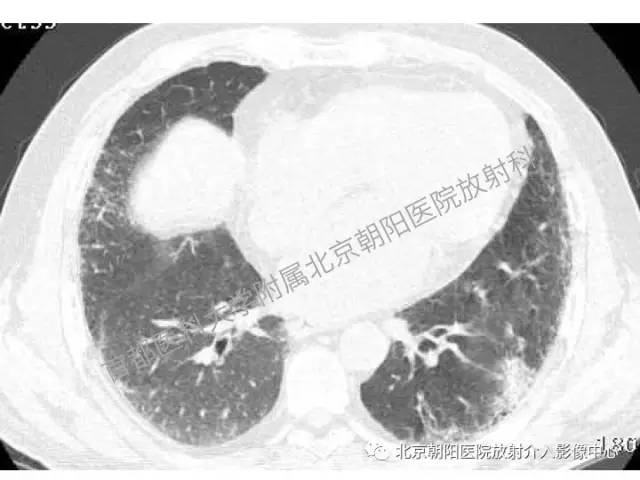 【三甲读片】这例看似肺炎的病变,多数人会误诊 【三甲读片】这例看似肺炎的病变,多数人会误诊