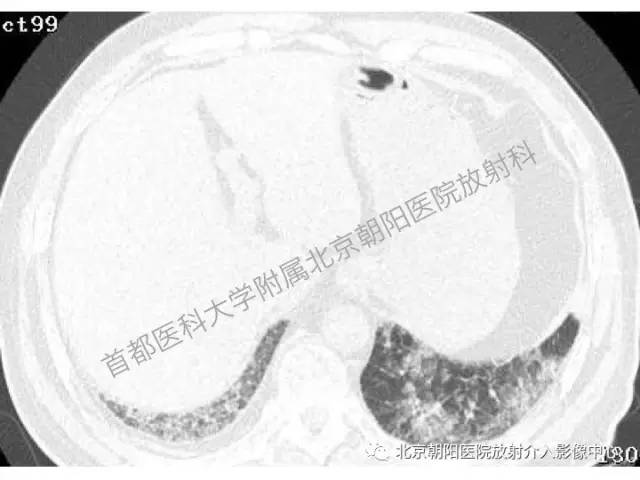 【三甲读片】这例看似肺炎的病变,多数人会误诊 【三甲读片】这例看似肺炎的病变,多数人会误诊