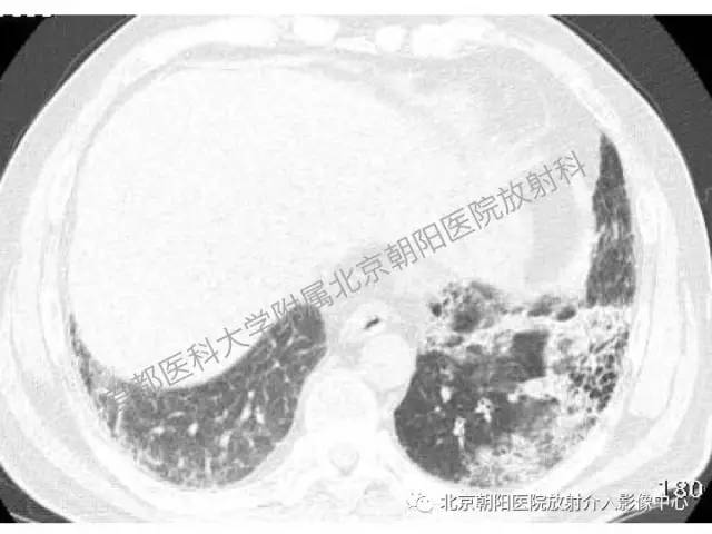 【三甲读片】这例看似肺炎的病变,多数人会误诊 【三甲读片】这例看似肺炎的病变,多数人会误诊
