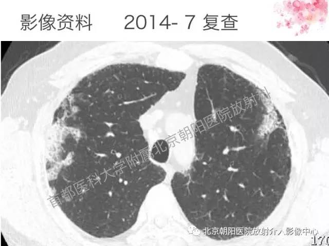 【三甲读片】这例看似肺炎的病变,多数人会误诊 【三甲读片】这例看似肺炎的病变,多数人会误诊