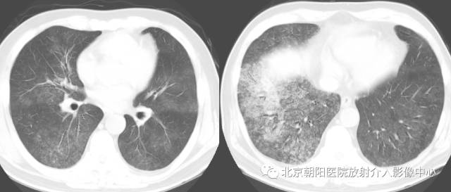 【三甲读片】这例看似肺炎的病变,多数人会误诊 【三甲读片】这例看似肺炎的病变,多数人会误诊
