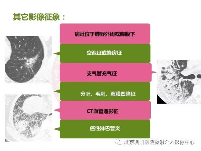 【三甲读片】这例看似肺炎的病变,多数人会误诊 【三甲读片】这例看似肺炎的病变,多数人会误诊