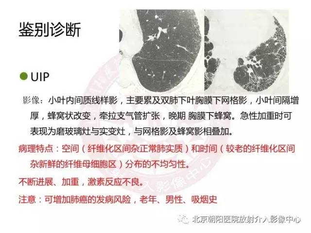 【三甲读片】这例看似肺炎的病变,多数人会误诊 【三甲读片】这例看似肺炎的病变,多数人会误诊