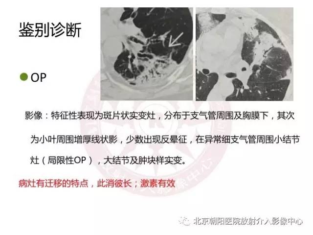 【三甲读片】这例看似肺炎的病变,多数人会误诊 【三甲读片】这例看似肺炎的病变,多数人会误诊