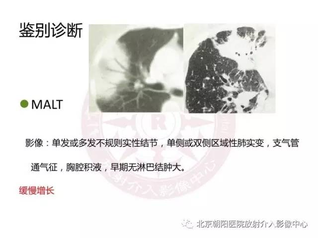 【三甲读片】这例看似肺炎的病变,多数人会误诊 【三甲读片】这例看似肺炎的病变,多数人会误诊