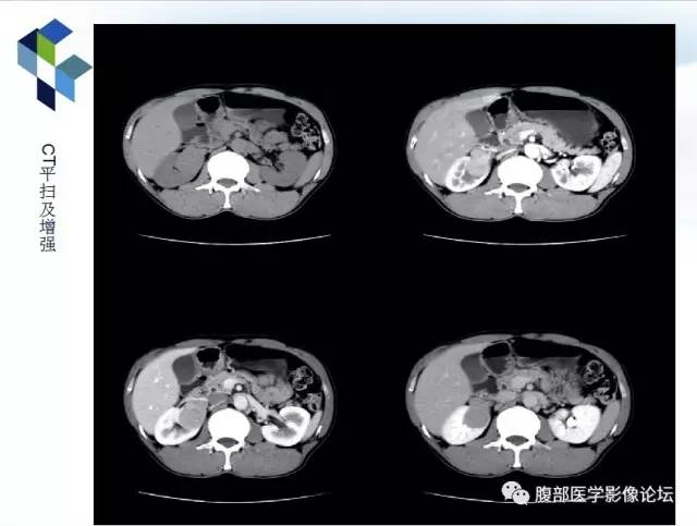 【病例】右肾类癌1例CT及MR影像表现
