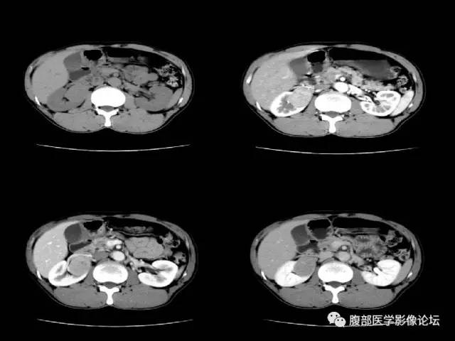 【病例】右肾类癌1例CT及MR影像表现
