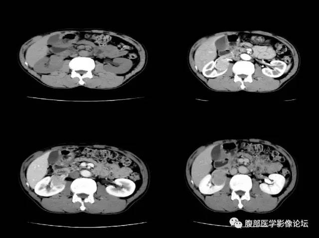 【病例】右肾类癌1例CT及MR影像表现