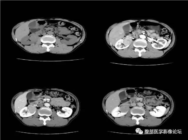 【病例】右肾类癌1例CT及MR影像表现