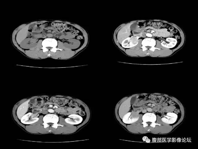 【病例】右肾类癌1例CT及MR影像表现