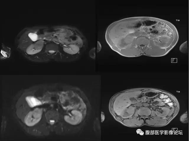 【病例】右肾类癌1例CT及MR影像表现