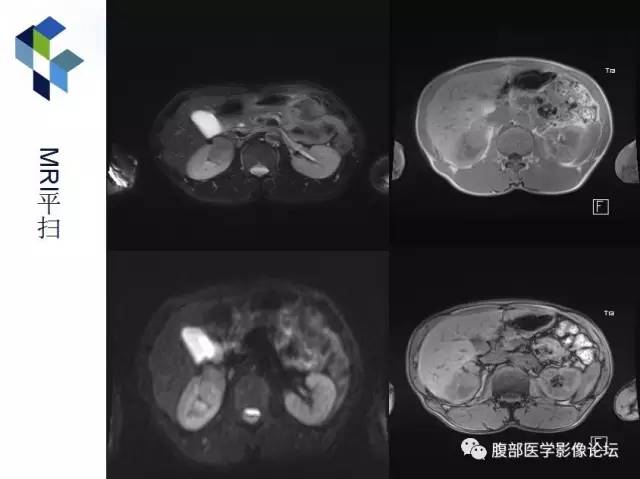 【病例】右肾类癌1例CT及MR影像表现
