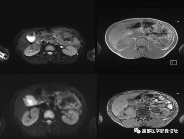 【病例】右肾类癌1例CT及MR影像表现
