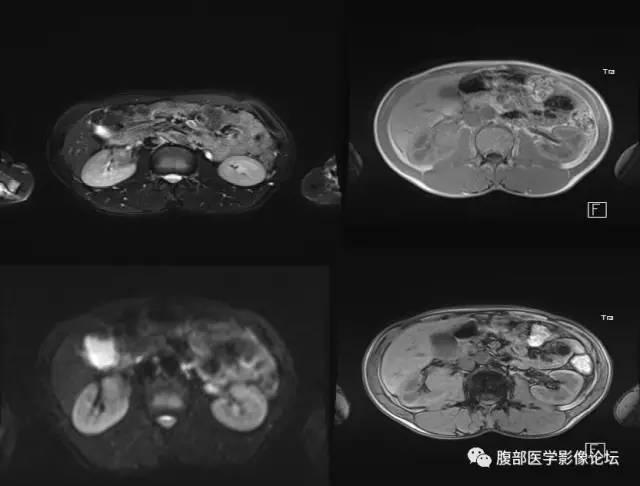 【病例】右肾类癌1例CT及MR影像表现