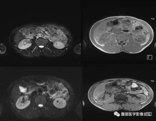【病例】右肾类癌1例CT及MR影像表现