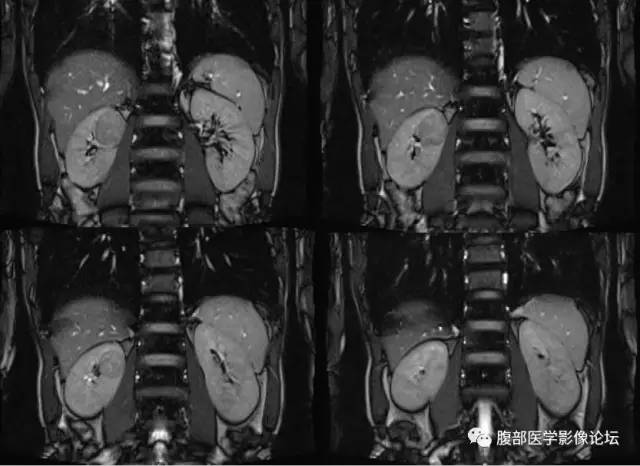 【病例】右肾类癌1例CT及MR影像表现