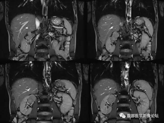 【病例】右肾类癌1例CT及MR影像表现