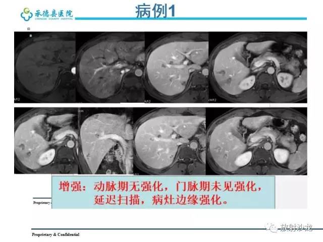【PPT】肝脏常见占位性病变影像表现及诊断思路