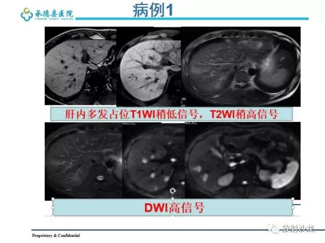 【PPT】肝脏常见占位性病变影像表现及诊断思路