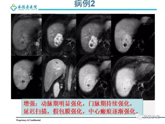 【PPT】肝脏常见占位性病变影像表现及诊断思路