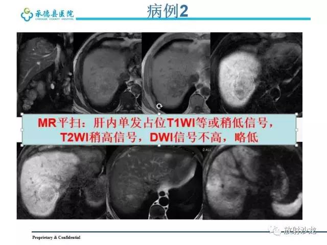 【PPT】肝脏常见占位性病变影像表现及诊断思路
