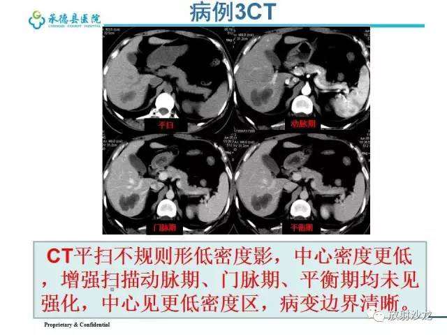 【PPT】肝脏常见占位性病变影像表现及诊断思路