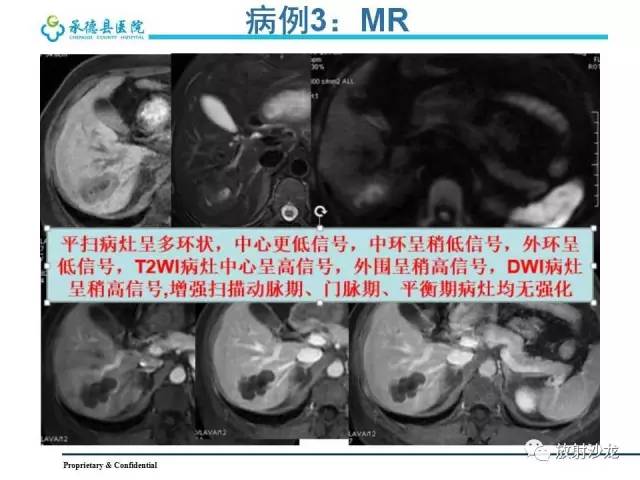 【PPT】肝脏常见占位性病变影像表现及诊断思路