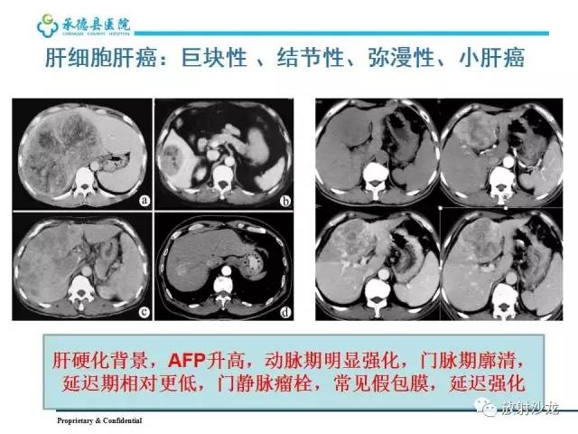 【PPT】肝脏常见占位性病变影像表现及诊断思路