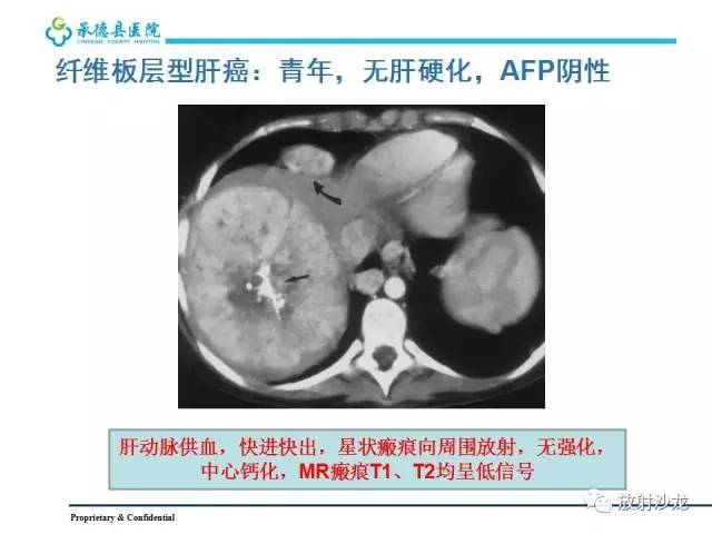 【PPT】肝脏常见占位性病变影像表现及诊断思路
