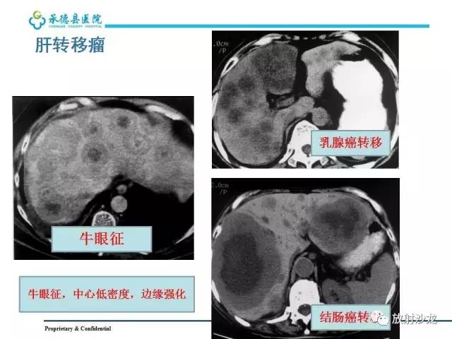 【PPT】肝脏常见占位性病变影像表现及诊断思路